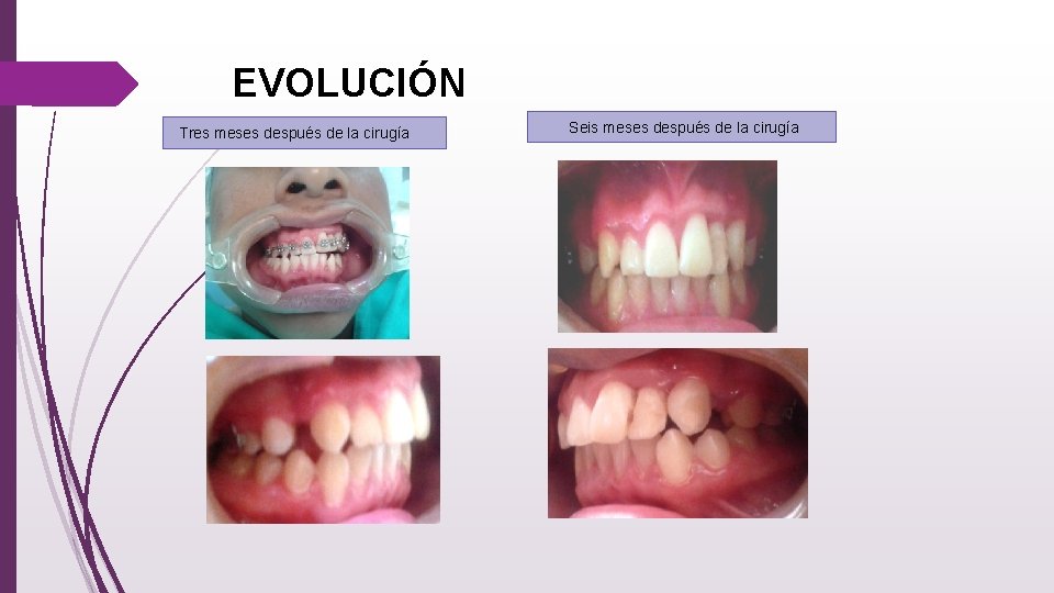EVOLUCIÓN Tres meses después de la cirugía Seis meses después de la cirugía 
