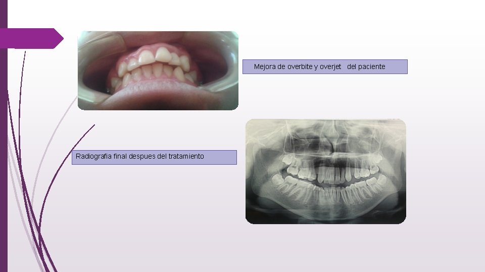  Mejora de overbite y overjet del paciente Radiografia final despues del tratamiento 