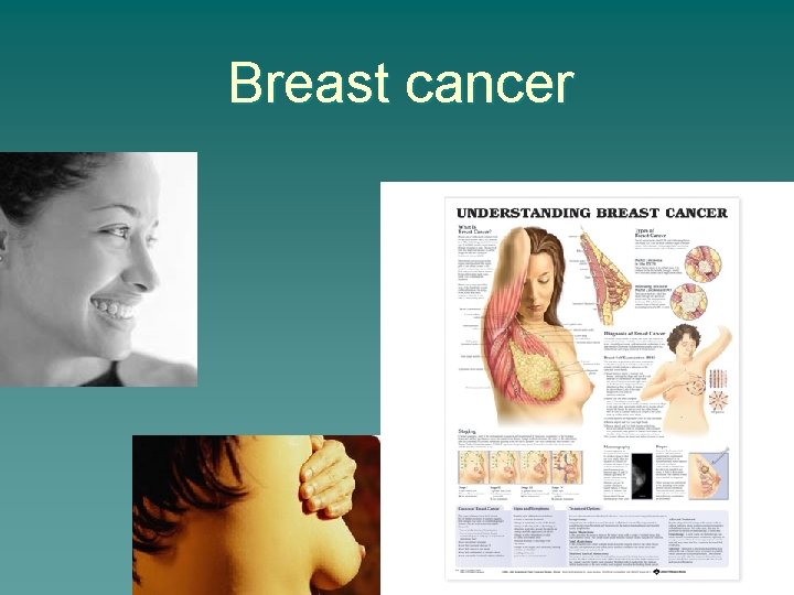 Breast cancer 