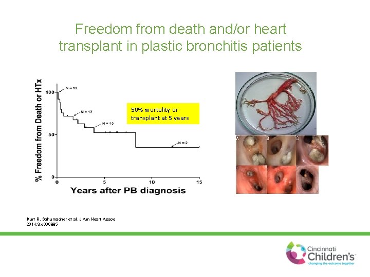 Freedom from death and/or heart transplant in plastic bronchitis patients 50% mortality or transplant