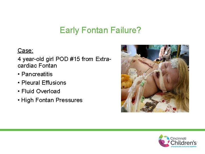 Early Fontan Failure? Case: 4 year-old girl POD #15 from Extracardiac Fontan • Pancreatitis