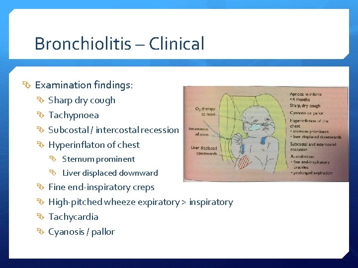 Bronchiolitis – Clinical Examination findings: Sharp dry cough Tachypnoea Subcostal / intercostal recession Hyperinflaton