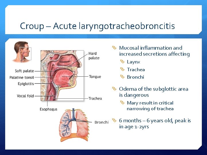Croup – Acute laryngotracheobroncitis Mucosal inflammation and increased secretions affecting Laynx Trachea Bronchi Odema