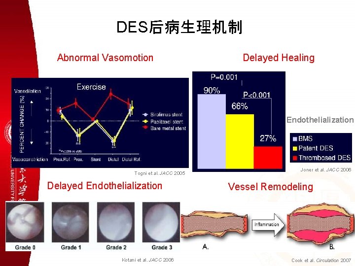 DES后病生理机制 Abnormal Vasomotion Delayed Healing Endothelialization Togni et al. JACC 2005 Delayed Endothelialization Kotani