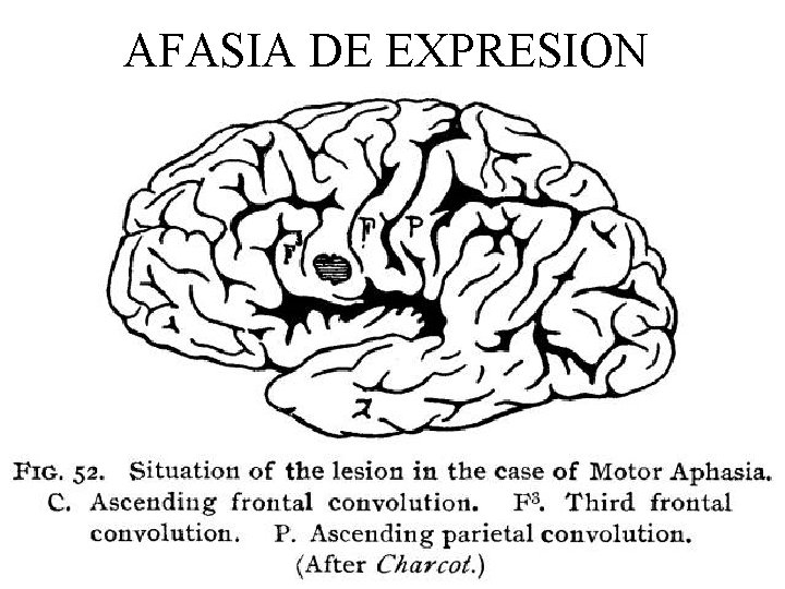 AFASIA DE EXPRESION 