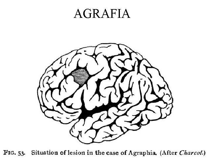 AGRAFIA 