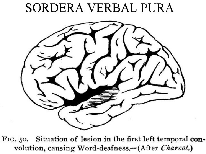 SORDERA VERBAL PURA 