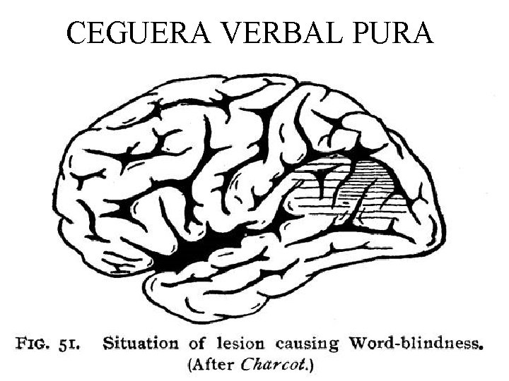 CEGUERA VERBAL PURA 