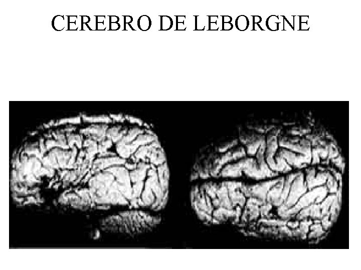 CEREBRO DE LEBORGNE 