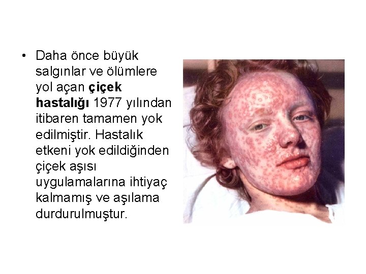  • Daha önce büyük salgınlar ve ölümlere yol açan çiçek hastalığı 1977 yılından