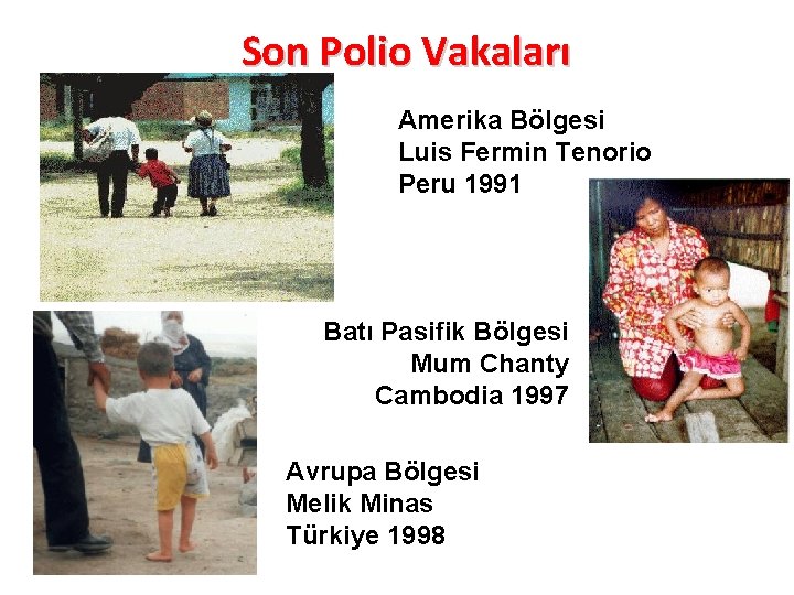 Son Polio Vakaları Amerika Bölgesi Luis Fermin Tenorio Peru 1991 Batı Pasifik Bölgesi Mum