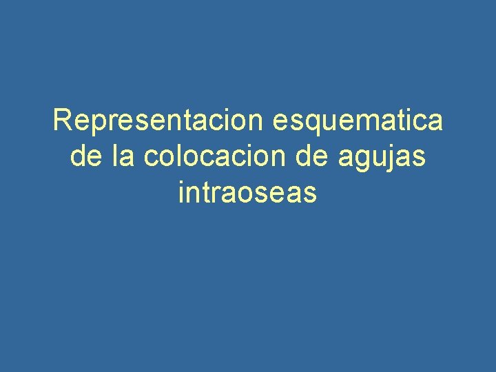 Representacion esquematica de la colocacion de agujas intraoseas 