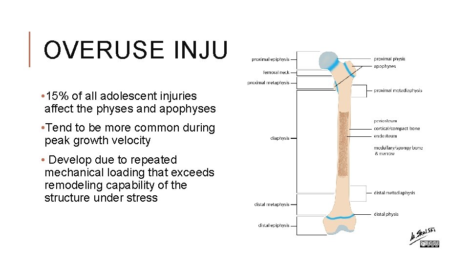 OVERUSE INJURIES • 15% of all adolescent injuries affect the physes and apophyses • OVERUSE INJURIES • 15% of all adolescent injuries affect the physes and apophyses •