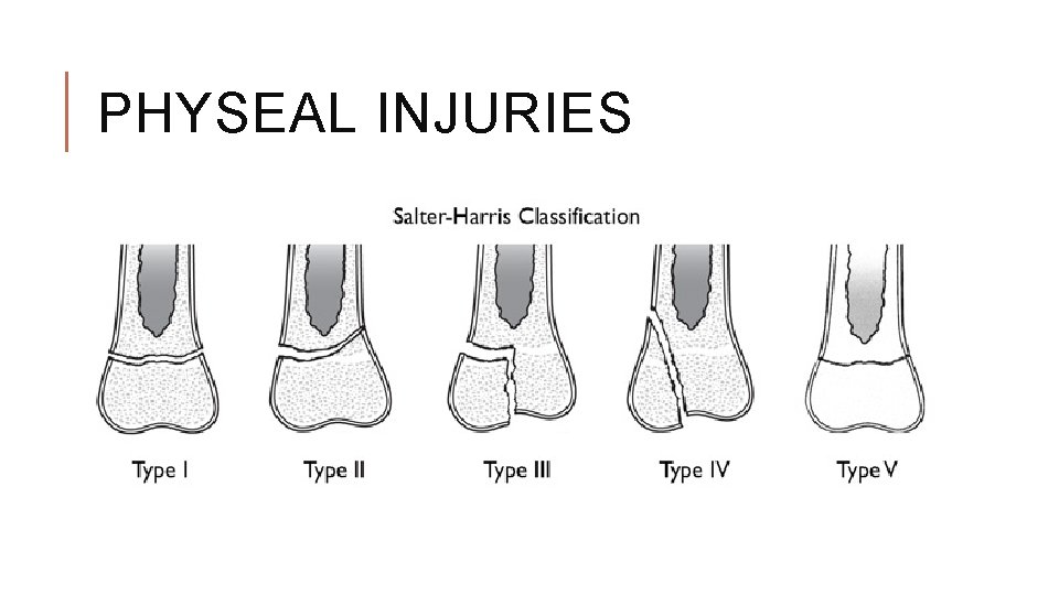 PHYSEAL INJURIES PHYSEAL INJURIES