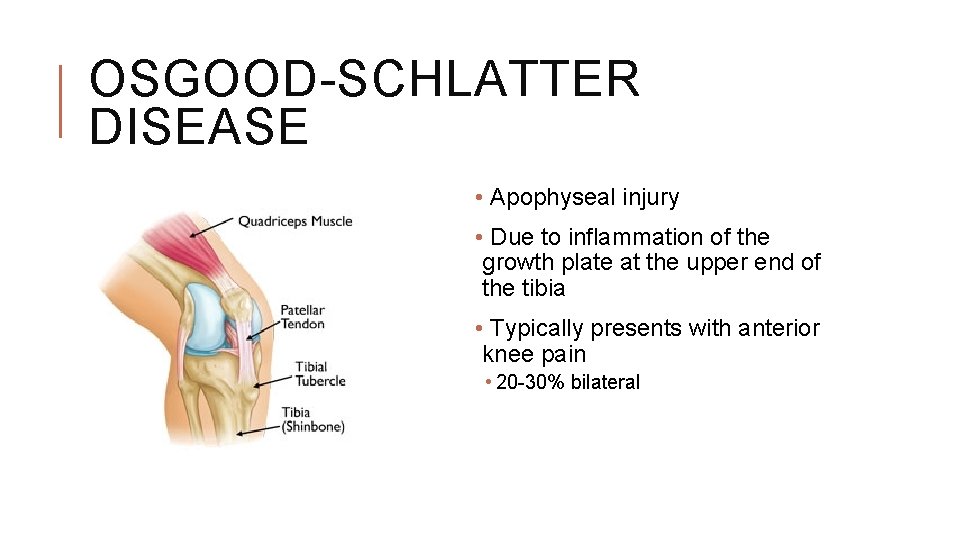 OSGOOD-SCHLATTER DISEASE • Apophyseal injury • Due to inflammation of the growth plate at OSGOOD-SCHLATTER DISEASE • Apophyseal injury • Due to inflammation of the growth plate at