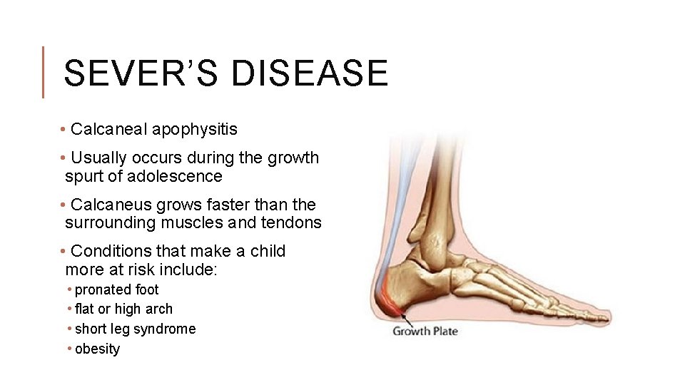 SEVER’S DISEASE • Calcaneal apophysitis • Usually occurs during the growth spurt of adolescence SEVER’S DISEASE • Calcaneal apophysitis • Usually occurs during the growth spurt of adolescence