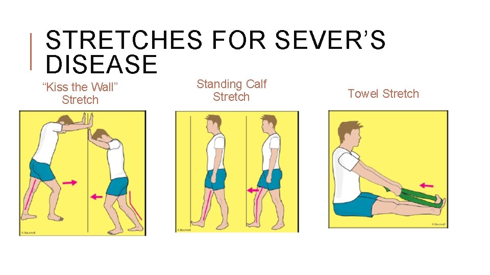 stretches for sever's disease Sever disease treatment exercises