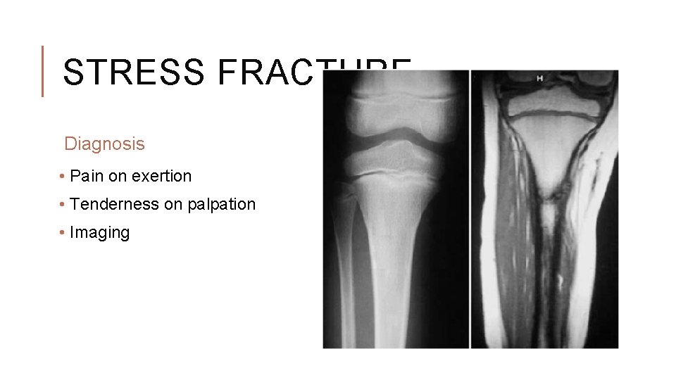 STRESS FRACTURE Diagnosis • Pain on exertion • Tenderness on palpation • Imaging STRESS FRACTURE Diagnosis • Pain on exertion • Tenderness on palpation • Imaging