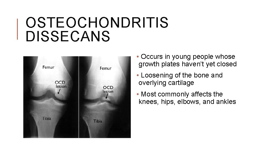 OSTEOCHONDRITIS DISSECANS • Occurs in young people whose growth plates haven’t yet closed • OSTEOCHONDRITIS DISSECANS • Occurs in young people whose growth plates haven’t yet closed •
