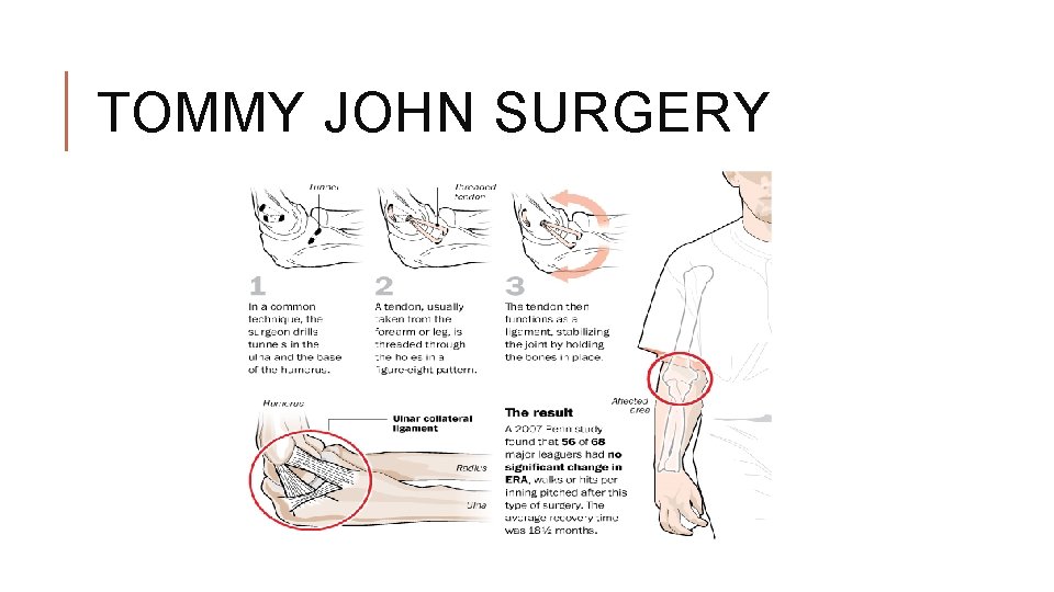 TOMMY JOHN SURGERY TOMMY JOHN SURGERY