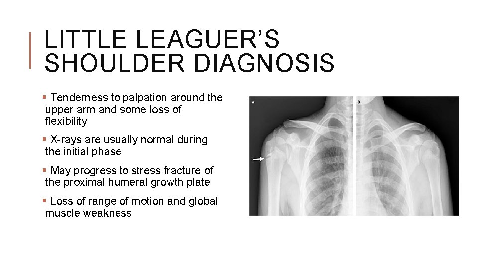 LITTLE LEAGUER’S SHOULDER DIAGNOSIS § Tenderness to palpation around the upper arm and some LITTLE LEAGUER’S SHOULDER DIAGNOSIS § Tenderness to palpation around the upper arm and some