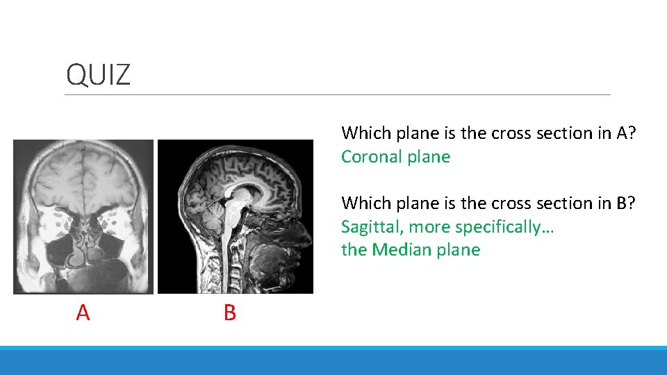 QUIZ Which plane is the cross section in A? Coronal plane Which plane is QUIZ Which plane is the cross section in A? Coronal plane Which plane is