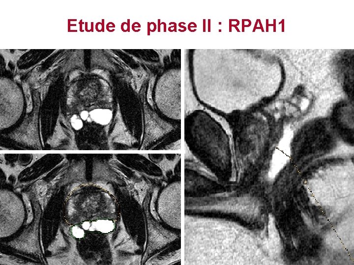 Injection d’acide hyaluronique Etude de phase II : RPAH 1 Injection d’acide hyaluronique Etude de phase II : RPAH 1