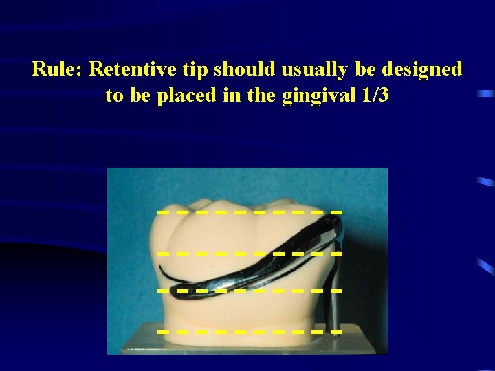 Rule: Retentive tip should usually be designed to be placed in the gingival 1/3