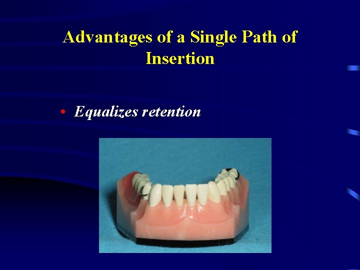 Advantages of a Single Path of Insertion • Equalizes retention 