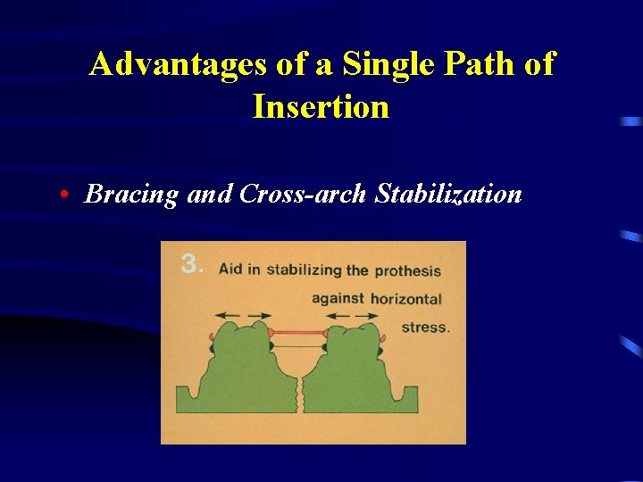 Advantages of a Single Path of Insertion • Bracing and Cross-arch Stabilization 