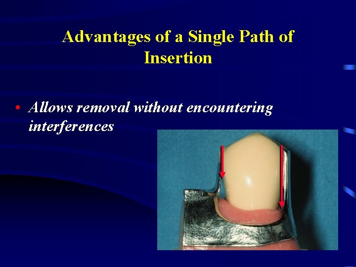 Advantages of a Single Path of Insertion • Allows removal without encountering interferences 