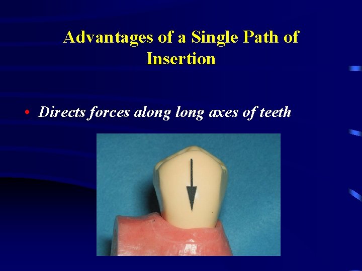 Advantages of a Single Path of Insertion • Directs forces along axes of teeth