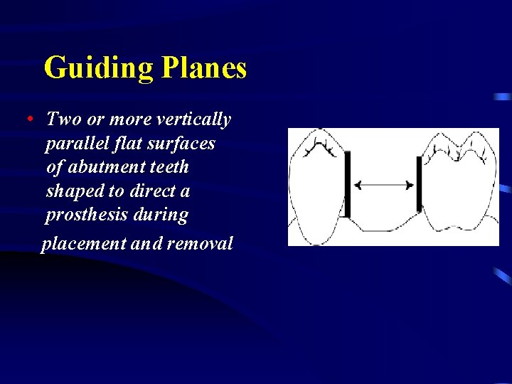 Guiding Planes • Two or more vertically parallel flat surfaces of abutment teeth shaped