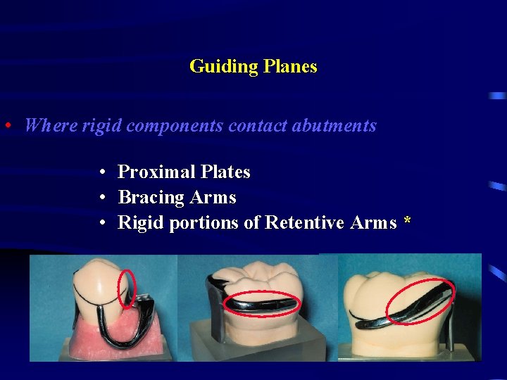 Guiding Planes • Where rigid components contact abutments • Proximal Plates • Bracing Arms