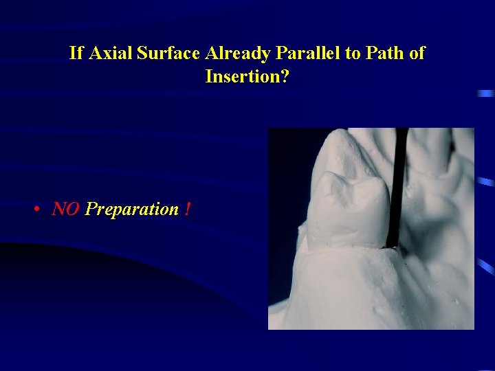 If Axial Surface Already Parallel to Path of Insertion? • NO Preparation ! 