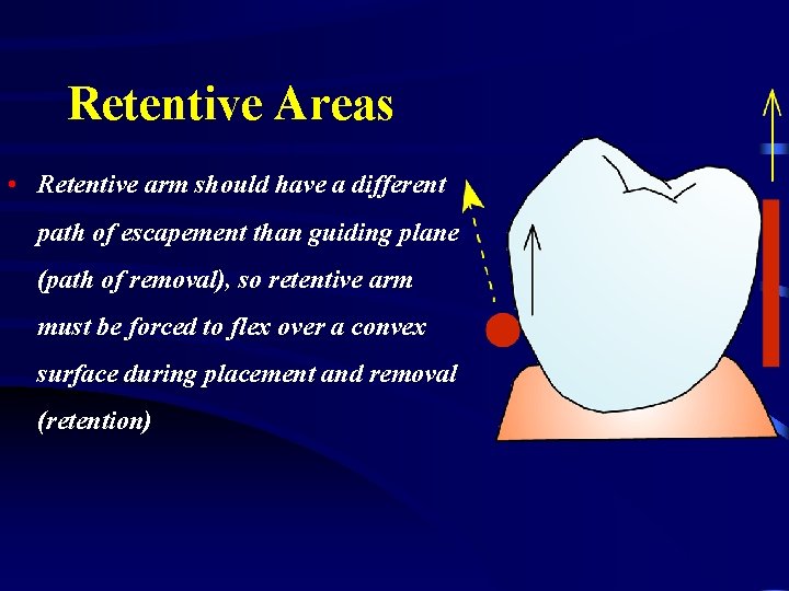 Retentive Areas • Retentive arm should have a different path of escapement than guiding