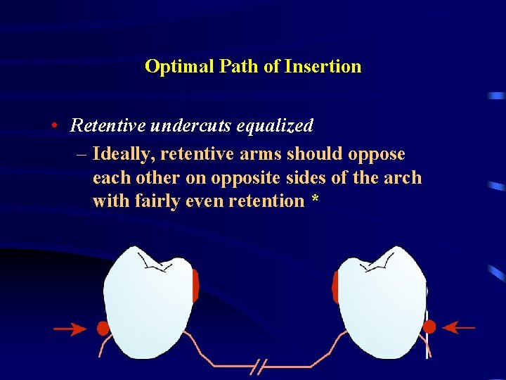 Optimal Path of Insertion • Retentive undercuts equalized – Ideally, retentive arms should oppose