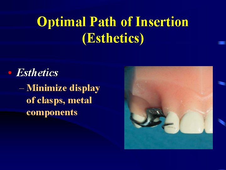 Optimal Path of Insertion (Esthetics) • Esthetics – Minimize display of clasps, metal components