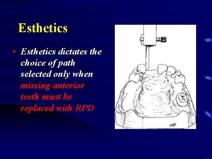 Esthetics • Esthetics dictates the choice of path selected only when missing anterior teeth