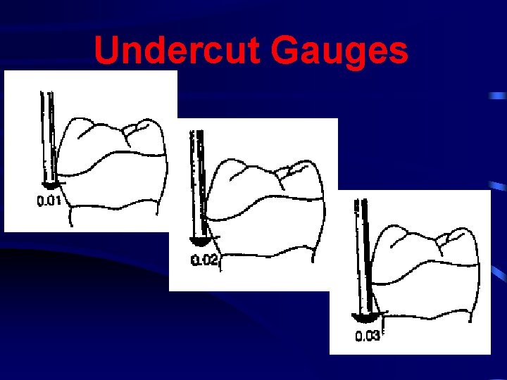 Undercut Gauges 