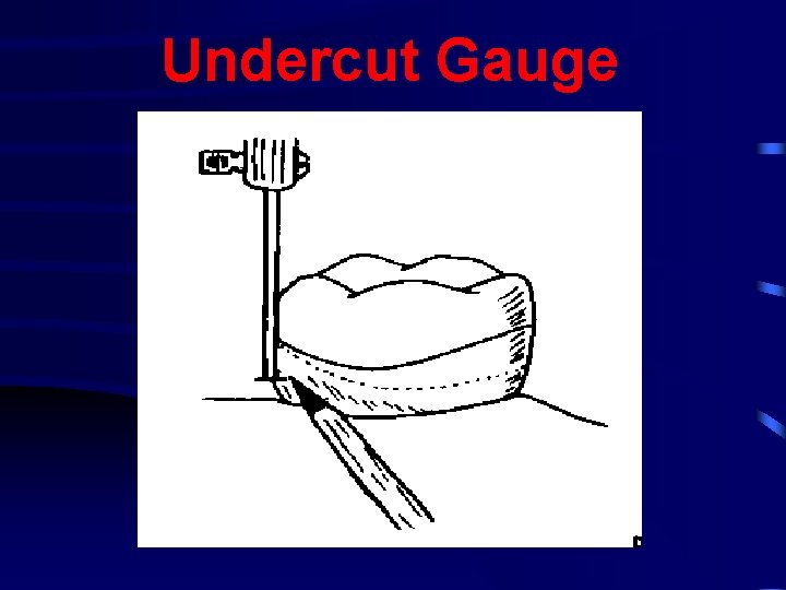 Undercut Gauge 