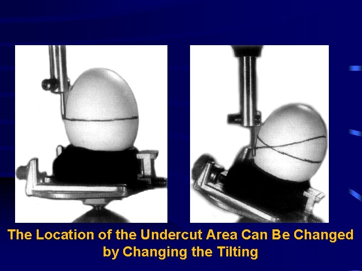 The Location of the Undercut Area Can Be Changed by Changing the Tilting 