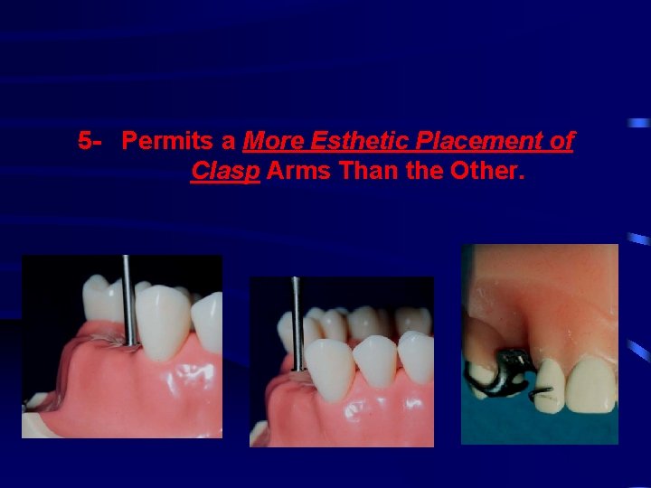 5 - Permits a More Esthetic Placement of Clasp Arms Than the Other. 