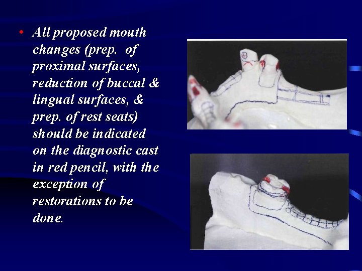  • All proposed mouth changes (prep. of proximal surfaces, reduction of buccal &