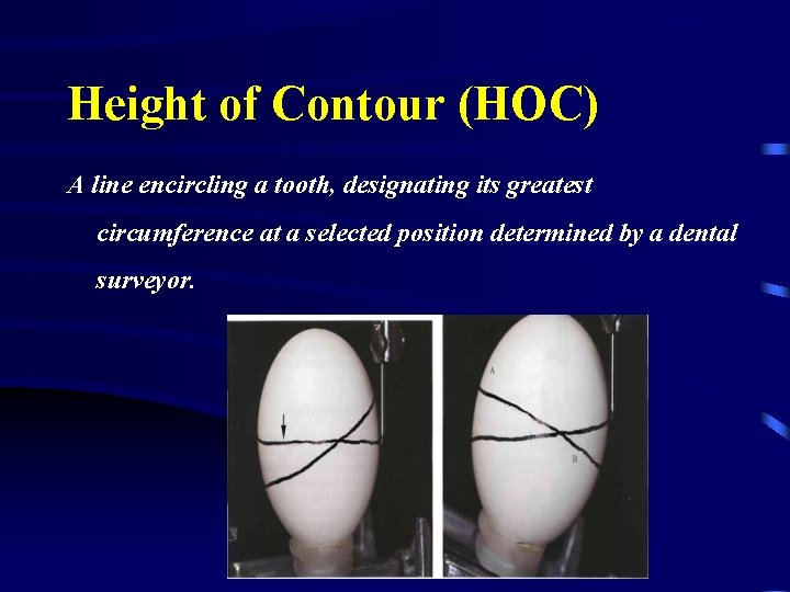 Height of Contour (HOC) A line encircling a tooth, designating its greatest circumference at