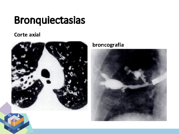 Bronquiectasias Corte axial broncografia 