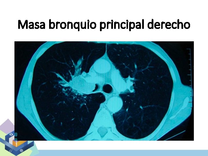 Masa bronquio principal derecho 