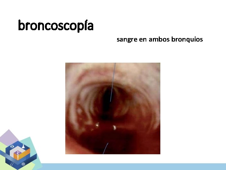 broncoscopía sangre en ambos bronquios 