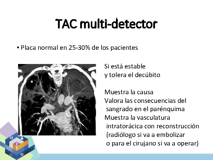 TAC multi-detector • Placa normal en 25 -30% de los pacientes Si está estable