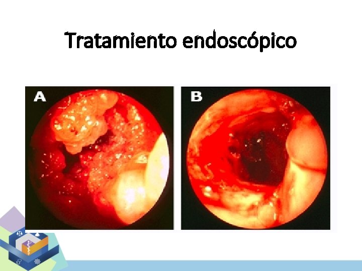 Tratamiento endoscópico 